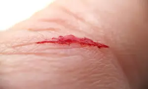 Nahaufnahme einer tiefen Schnittwunde mit Blut auf der Haut.