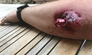 Arm mit blutiger Wunde, Knochen sichtbar. Erste Hilfe bei offenem Bruch ist dringend nötig.