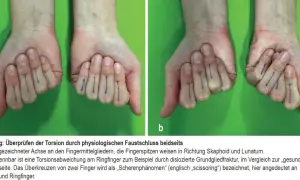 Hände mit blauen Markierungen an den Fingern. Bild b zeigt eine Verdrehung am Ringfinger, die auf einen gebrochenen daumenendgelenk hindeuten könnte.