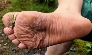 Fuß mit Blasen, die mit Pflaster versorgt sind. Ein Zeichen, dass man wissen muss, was tun gegen Blasen beim Wandern.