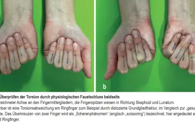 Hände mit blauen Markierungen an den Fingern. Bild b zeigt eine Verdrehung am Ringfinger, die auf einen gebrochenen daumenendgelenk hindeuten könnte.