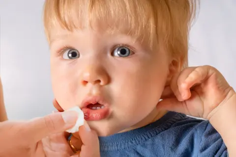 Ein Kind mit blauen Augen und blonden Haaren bekommt die Lippe mit einem Tupfer versorgt. Die Lippe zeigt eine kleine, blutende Platzwunde.