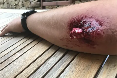 Arm mit blutiger Wunde, Knochen sichtbar. Erste Hilfe bei offenem Bruch ist dringend nötig.
