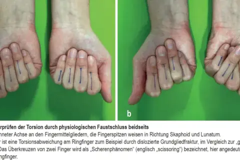 Hände mit blauen Markierungen an den Fingern. Bild b zeigt eine Verdrehung am Ringfinger, die auf einen gebrochenen daumenendgelenk hindeuten könnte.