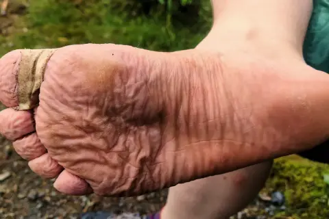 Fuß mit Blasen, die mit Pflaster versorgt sind. Ein Zeichen, dass man wissen muss, was tun gegen Blasen beim Wandern.