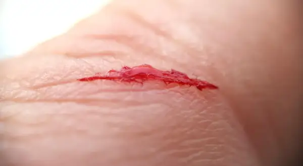 Nahaufnahme einer tiefen Schnittwunde mit Blut auf der Haut.