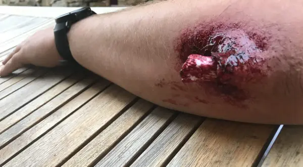 Arm mit blutiger Wunde, Knochen sichtbar. Erste Hilfe bei offenem Bruch ist dringend nötig.