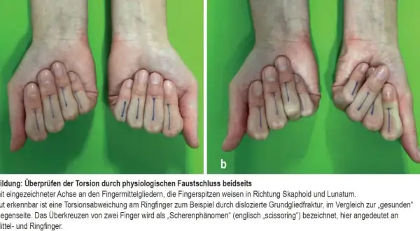 Hände mit blauen Markierungen an den Fingern. Bild b zeigt eine Verdrehung am Ringfinger, die auf einen gebrochenen daumenendgelenk hindeuten könnte.