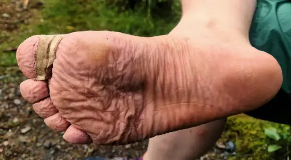 Fuß mit Blasen, die mit Pflaster versorgt sind. Ein Zeichen, dass man wissen muss, was tun gegen Blasen beim Wandern.