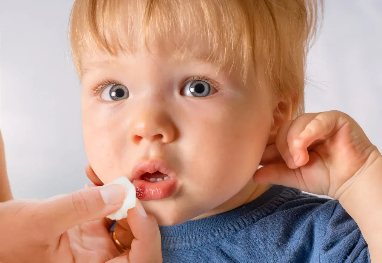 Ein Kind mit blauen Augen und blonden Haaren bekommt die Lippe mit einem Tupfer versorgt. Die Lippe zeigt eine kleine, blutende Platzwunde.
