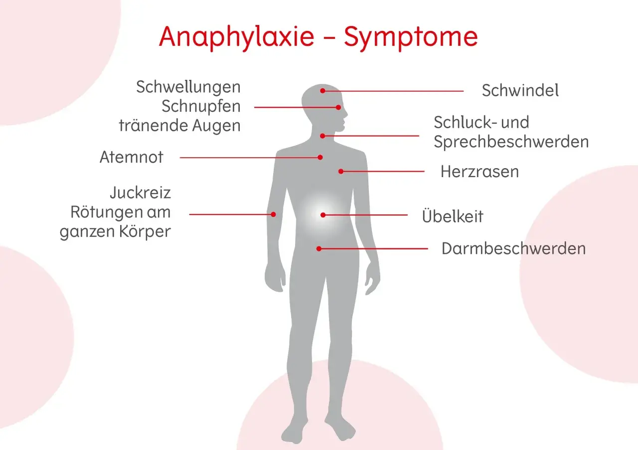 Anaphylaxie-Symptome: Schwellungen, Schnupfen, tränende Augen, Atemnot, Juckreiz, Rötungen, Schwindel, Schluck-/Sprechbeschwerden, Herzrasen, Übelkeit, Darmbeschwerden. Erste Hilfe ist wichtig!