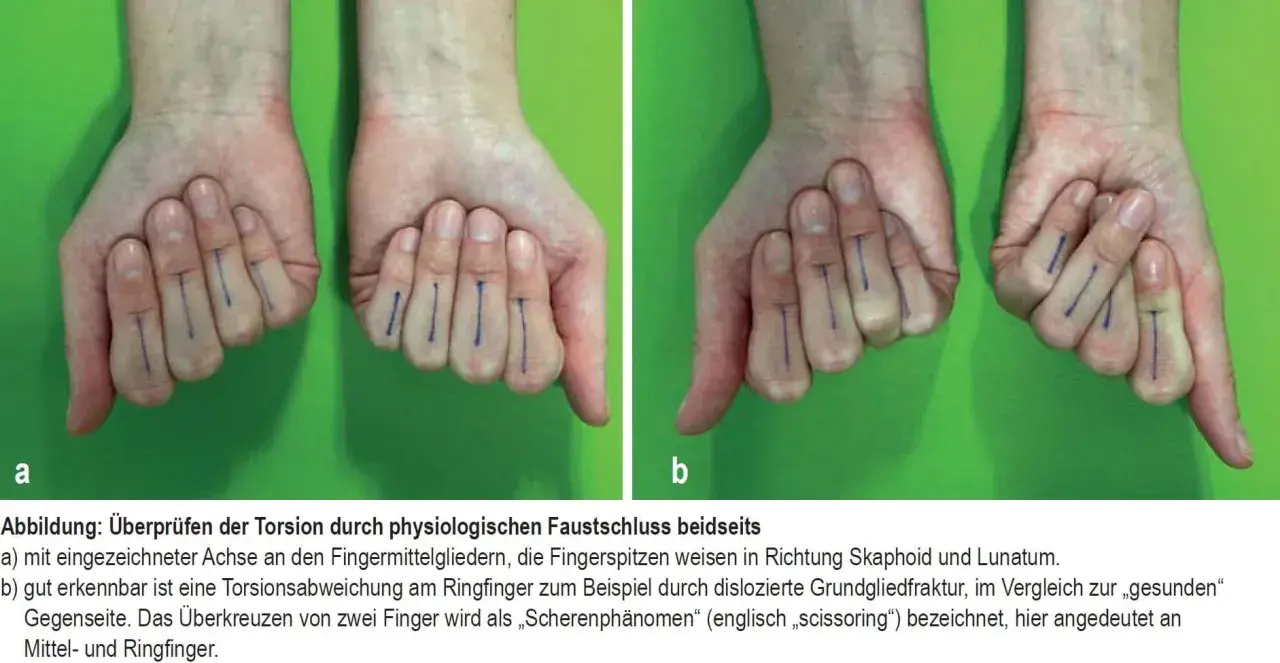Hände mit blauen Markierungen an den Fingern. Bild b zeigt eine Verdrehung am Ringfinger, die auf einen gebrochenen daumenendgelenk hindeuten könnte.