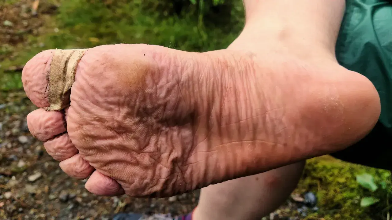 Fuß mit Blasen, die mit Pflaster versorgt sind. Ein Zeichen, dass man wissen muss, was tun gegen Blasen beim Wandern.
