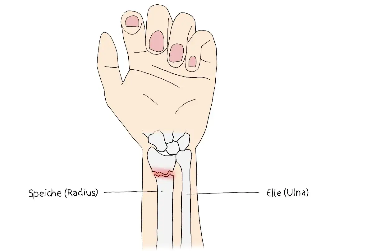 Illustration zeigt einen Bruch der Speiche (Radius) am Handgelenk. Der daumenendgelenk gebrochen ist nicht direkt dargestellt, aber der Bruch am Handgelenk ist sichtbar.