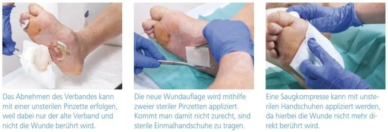 Fu&szlig;wunde: Verband vorsichtig mit Pinzette entfernen. Neue Auflage mit sterilen Pinzetten oder Handschuhen anlegen.