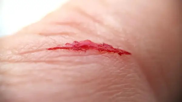 Nahaufnahme einer tiefen Schnittwunde mit Blut auf der Haut.