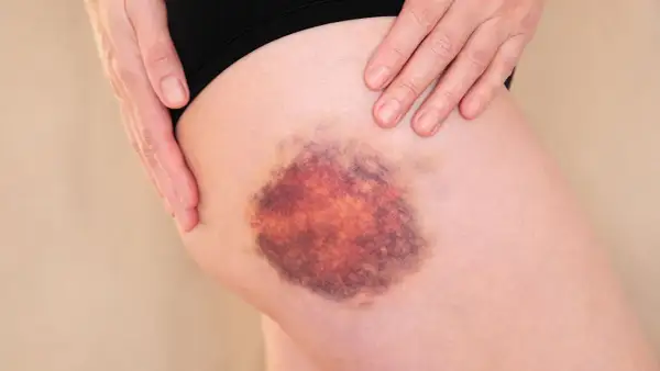 Ein großer, blauer Fleck, ein pferdekuss oberschenkel seitlich, bedeckt die Haut. Hände berühren sanft die betroffene Stelle.