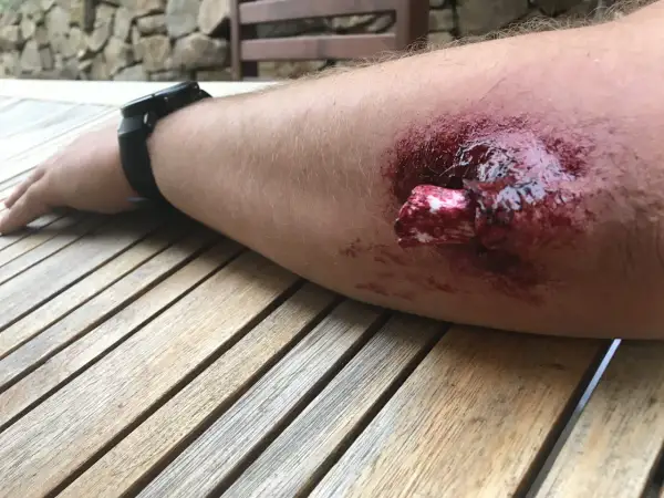 Arm mit blutiger Wunde, Knochen sichtbar. Erste Hilfe bei offenem Bruch ist dringend nötig.